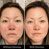 Omnilux Contour Face